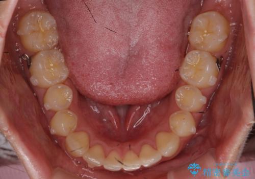 下の前歯が1本短い インビザラインと部分矯正の組み合わせの治療中