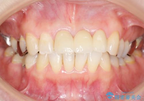 不自然なブリッジ 自然なセラミックでやりかえ 30代女性の治療後