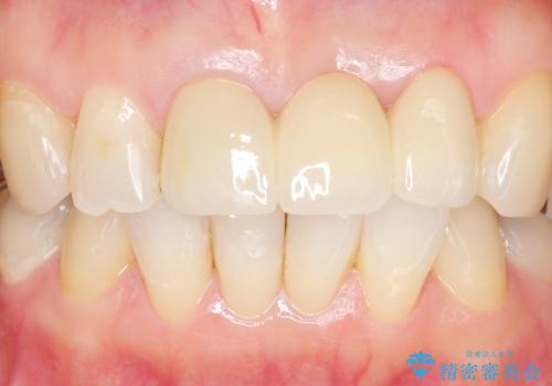 不自然なブリッジ 自然なセラミックでやりかえ 30代女性の治療後