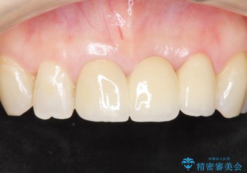 不自然なブリッジ 自然なセラミックでやりかえ 30代女性の治療後