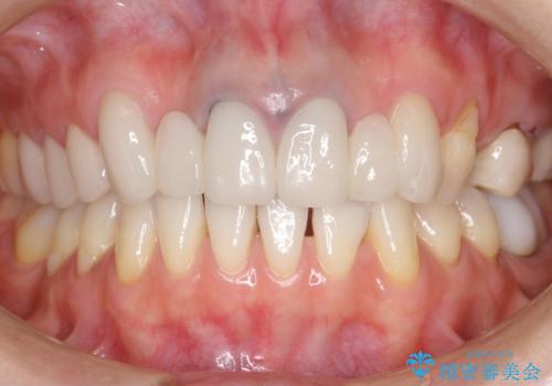 他院で仮歯まで入れたが違和感がある 40代女性の治療後