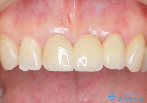 不自然なブリッジ 自然なセラミックでやりかえ 30代女性の治療後