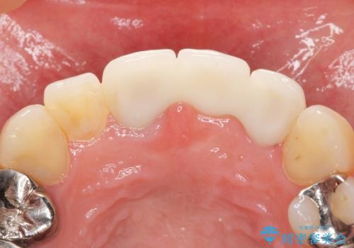 不自然なブリッジ 自然なセラミックでやりかえ 30代女性の治療後