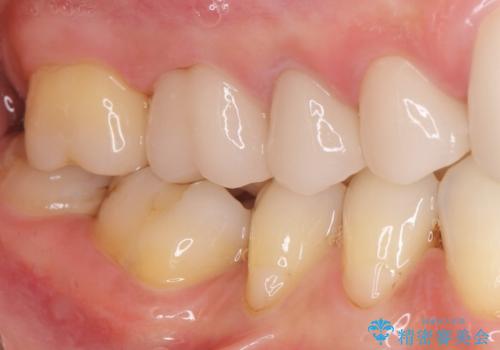 他院で仮歯まで入れたが違和感がある 40代女性の治療後