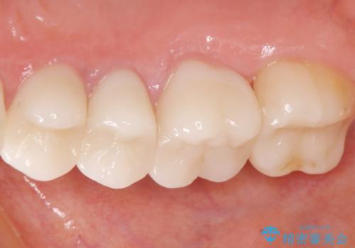 他院で仮歯まで入れたが違和感がある 40代女性の治療後