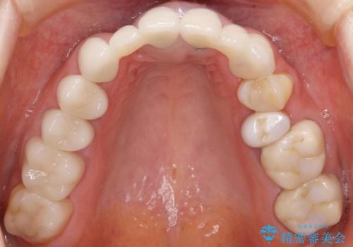 他院で仮歯まで入れたが違和感がある 40代女性の治療後