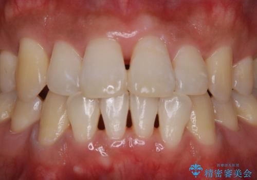 コーヒーによる歯の着色をきれいにの治療後