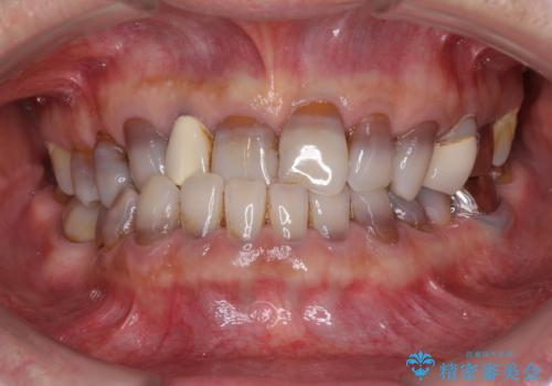 下の歯が前に出てしまう咬み合わせを治したい　インビザラインによる矯正治療の治療前