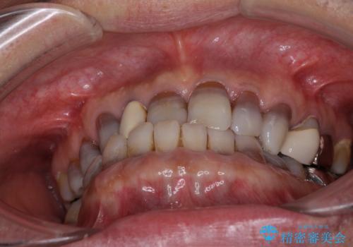 下の歯が前に出てしまう咬み合わせを治したい インビザラインによる矯正治療の治療前