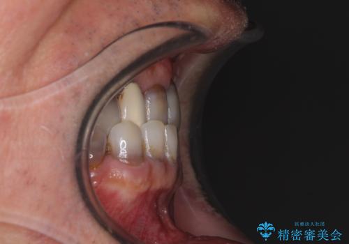 下の歯が前に出てしまう咬み合わせを治したい インビザラインによる矯正治療の治療前