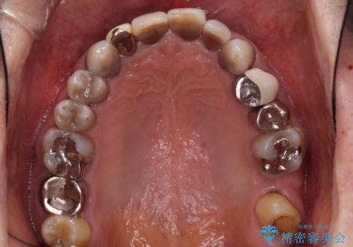 下の歯が前に出てしまう咬み合わせを治したい インビザラインによる矯正治療の治療前