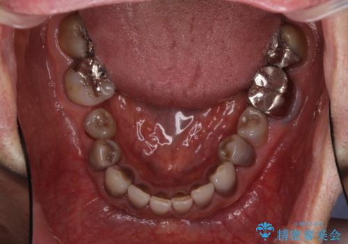 下の歯が前に出てしまう咬み合わせを治したい インビザラインによる矯正治療の治療前