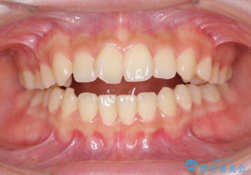 話しにくいオープンバイト ワイヤー装置による抜歯矯正治療の症例 治療前