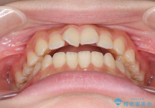 話しにくいオープンバイト ワイヤー装置による抜歯矯正治療の治療前