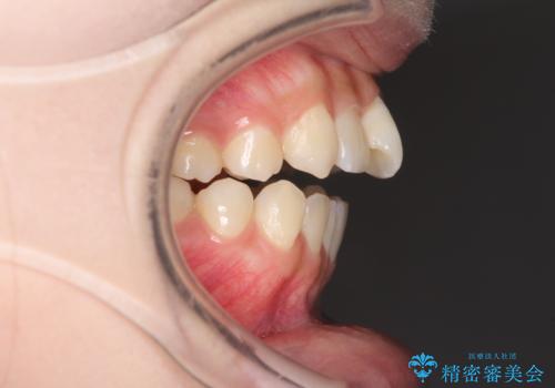 話しにくいオープンバイト ワイヤー装置による抜歯矯正治療の治療前