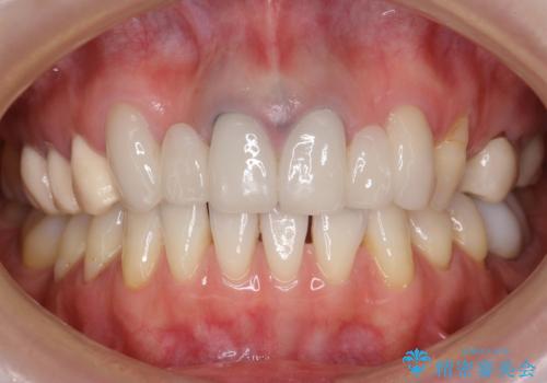 他院で仮歯まで入れたが違和感がある 40代女性の治療前