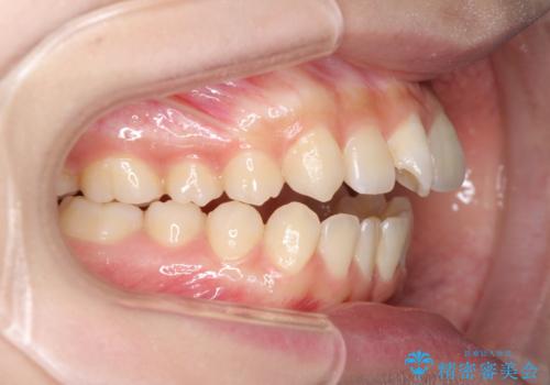 話しにくいオープンバイト ワイヤー装置による抜歯矯正治療の治療前