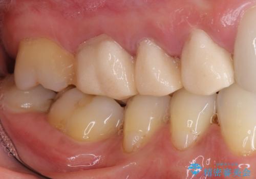 他院で仮歯まで入れたが違和感がある 40代女性の治療前
