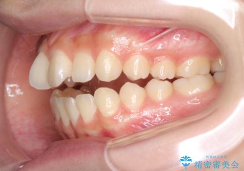 話しにくいオープンバイト ワイヤー装置による抜歯矯正治療の治療前