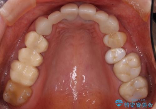 他院で仮歯まで入れたが違和感がある 40代女性の治療前