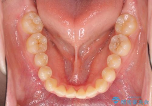 話しにくいオープンバイト ワイヤー装置による抜歯矯正治療の治療前