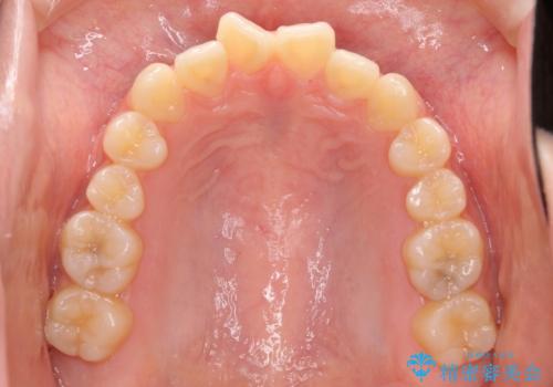 話しにくいオープンバイト ワイヤー装置による抜歯矯正治療の治療前