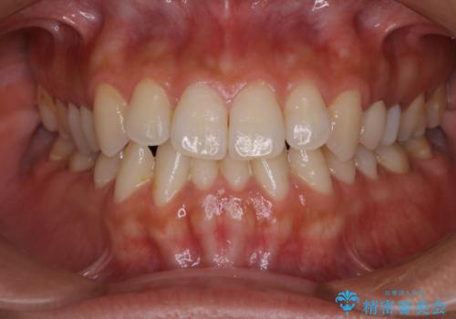 海外へ行く前にクリーニングできれいにしたいの治療前