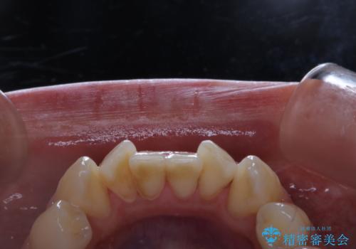 海外へ行く前にクリーニングできれいにしたいの治療前