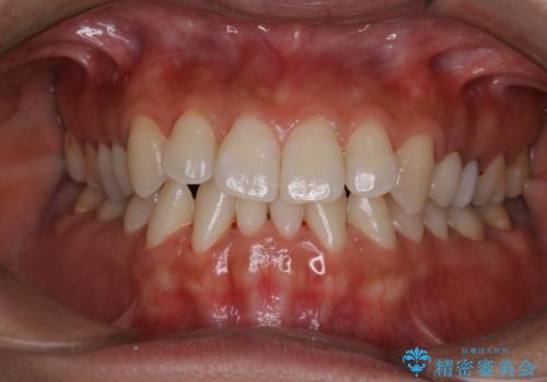 海外へ行く前にクリーニングできれいにしたいの治療後