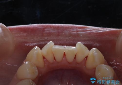 海外へ行く前にクリーニングできれいにしたいの治療後