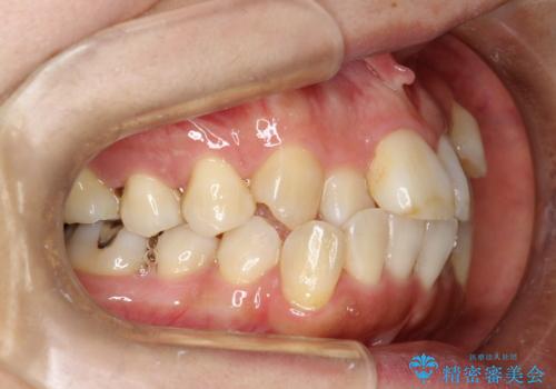 矯正治療が始まる前に歯のお掃除の治療前