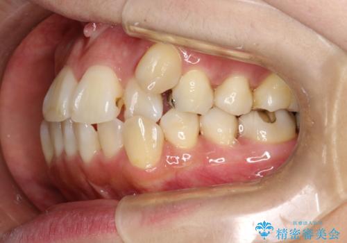 矯正治療が始まる前に歯のお掃除の治療前