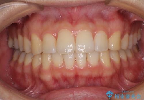 インビザライン・ライトによる矯正治療の後戻り改善の治療中