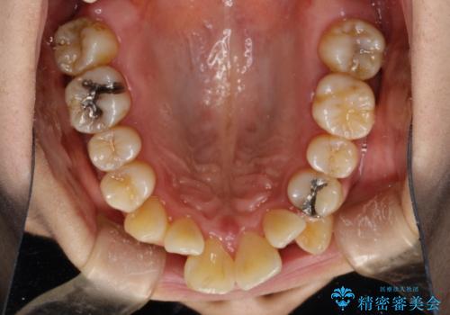 矯正治療が始まる前に歯のお掃除の治療前