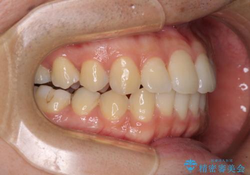 インビザライン・ライトによる矯正治療の後戻り改善の治療中