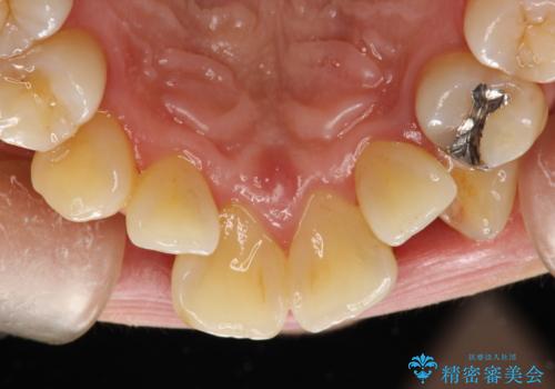 矯正治療が始まる前に歯のお掃除の治療前