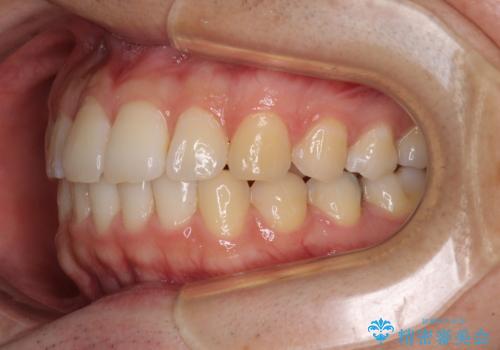 インビザライン・ライトによる矯正治療の後戻り改善の治療中