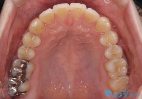 インビザライン・ライトによる矯正治療の後戻り改善の治療中