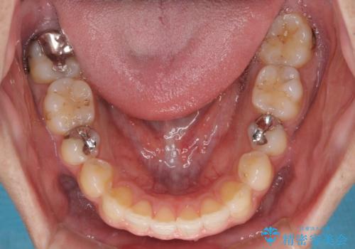 インビザライン・ライトによる矯正治療の後戻り改善の治療中