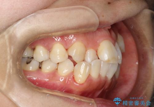 矯正治療が始まる前に歯のお掃除の治療後