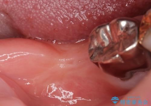 骨が少なくインプラントできないと言われた 下の奥歯のインプラント 60代男性の治療前