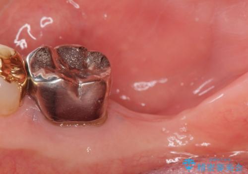 骨が少なくインプラントできないと言われた 下の奥歯のインプラント 60代男性の治療前