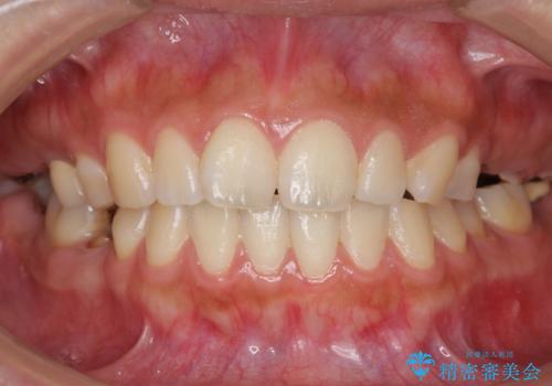 インプラントも入れ歯も嫌 親知らずの移植 20代女性の治療前