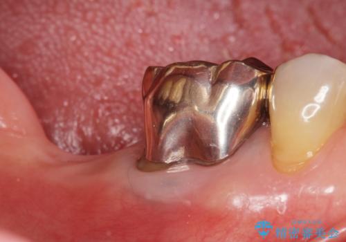 骨が少なくインプラントできないと言われた 下の奥歯のインプラント 60代男性の治療前