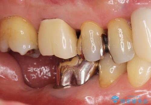 骨が少なくインプラントできないと言われた 下の奥歯のインプラント 60代男性の症例 治療前