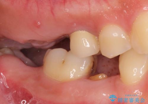 インプラントも入れ歯も嫌 親知らずの移植 20代女性の治療前