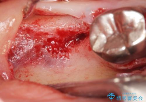 骨が少なくインプラントできないと言われた 下の奥歯のインプラント 60代男性の治療中