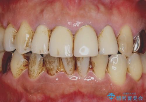 老朽化した前歯のクラウンやりかえの治療前