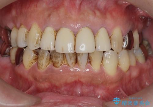 老朽化した前歯のクラウンやりかえの治療前