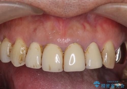 老朽化した前歯のクラウンやりかえの治療前